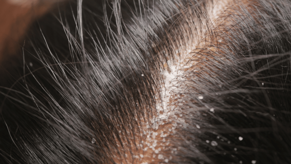 dandruff problem