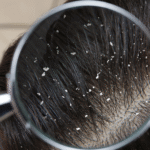 effective remedies for dandruff