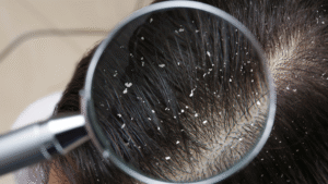 effective remedies for dandruff