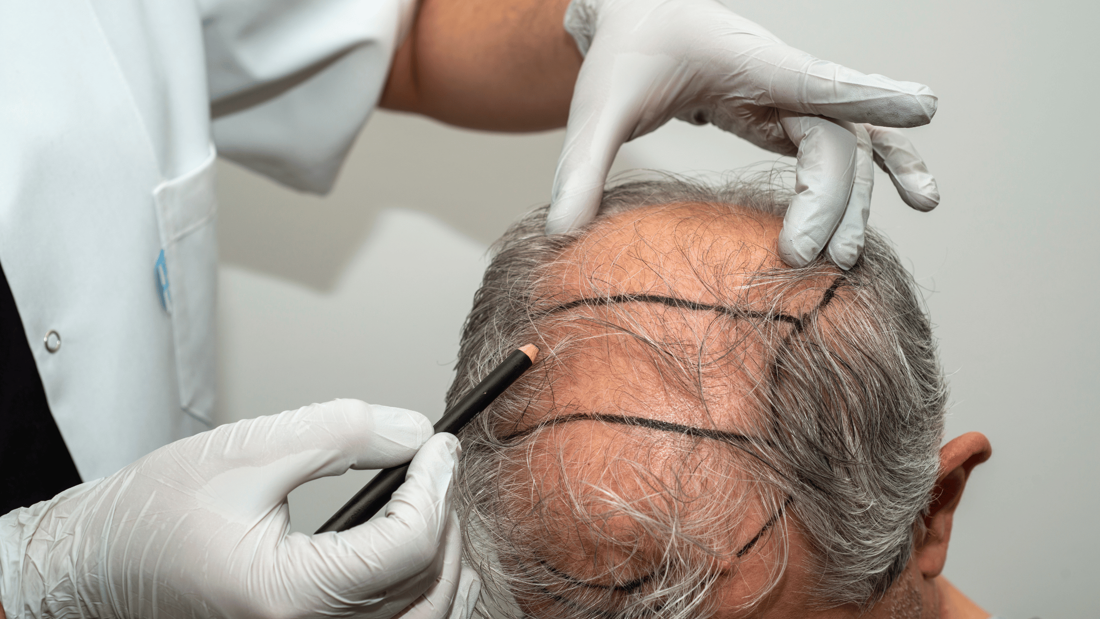 hair transplant surgery zirakpur