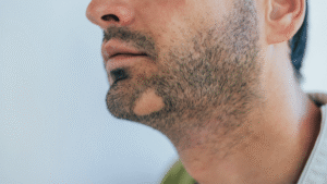 beard hair loss patch