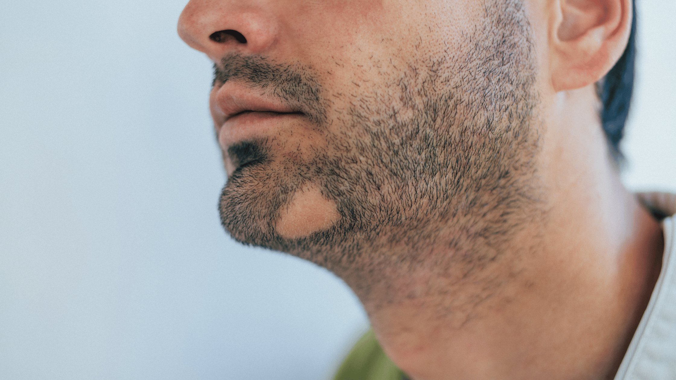 beard hair loss patch