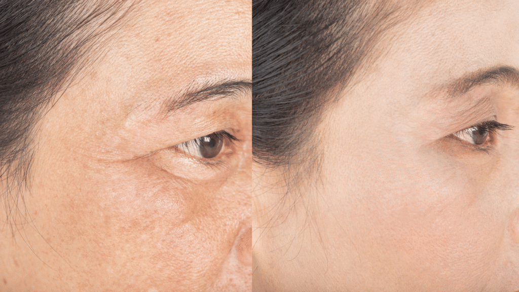 fine lines around eyes treatment at clinic reborn