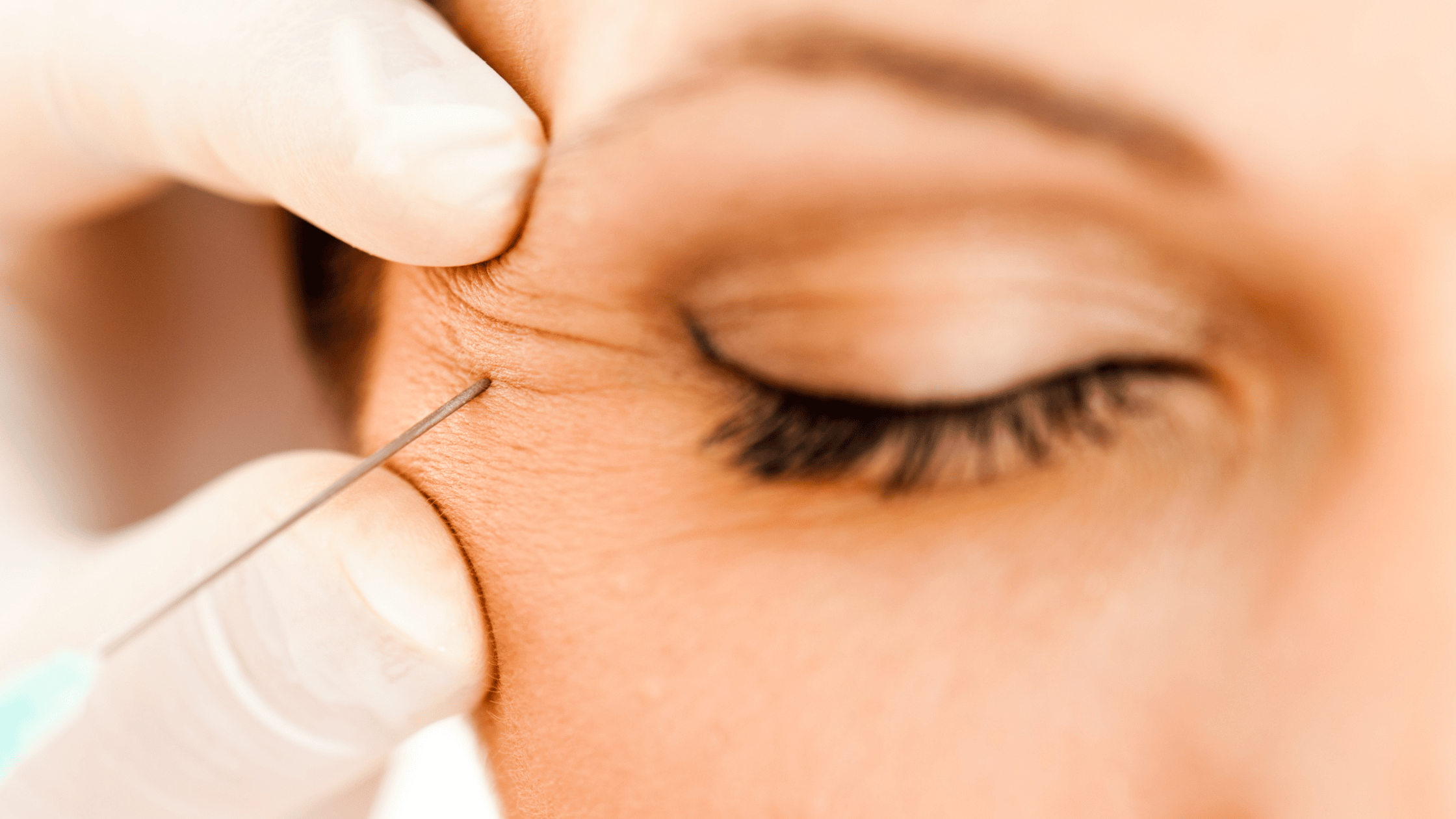 botox near eyes