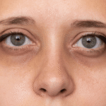 dark circles