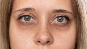 dark circles
