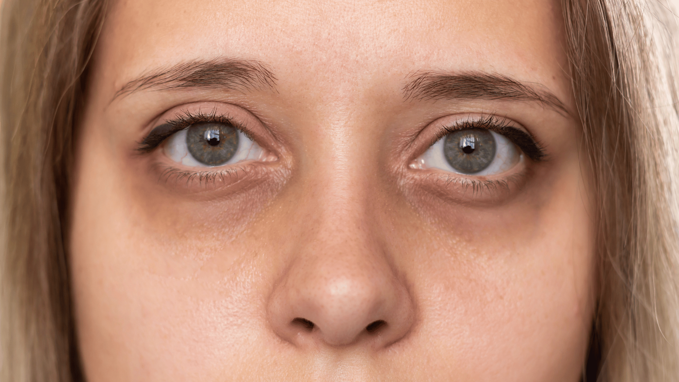 dark circles