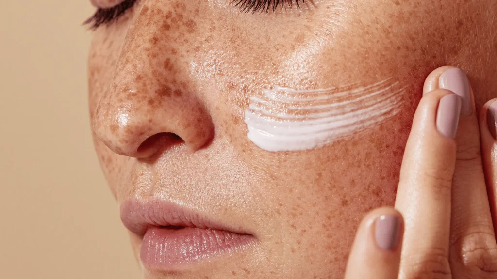 melasma