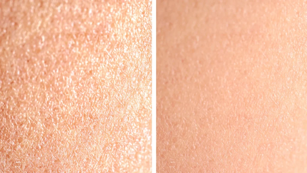 melasma before after