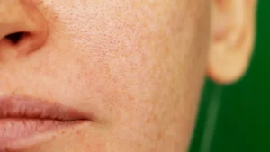 pigmentation