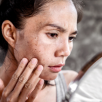remove facial pigmentation at reborn