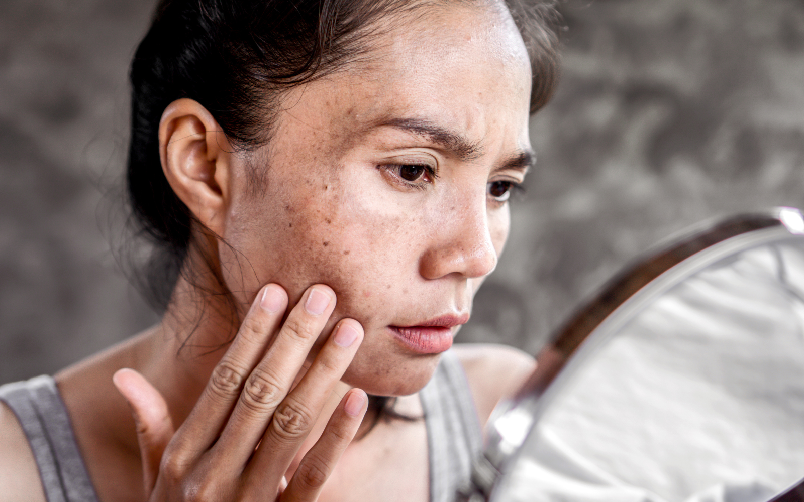 remove facial pigmentation at reborn