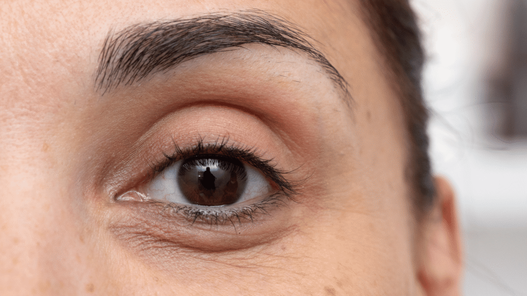 under eye dark circles
