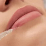 Lip-Fillers-_Img