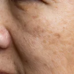 pigmentation treatment