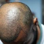is hair transplant painful