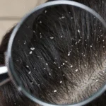 effective remedies for dandruff